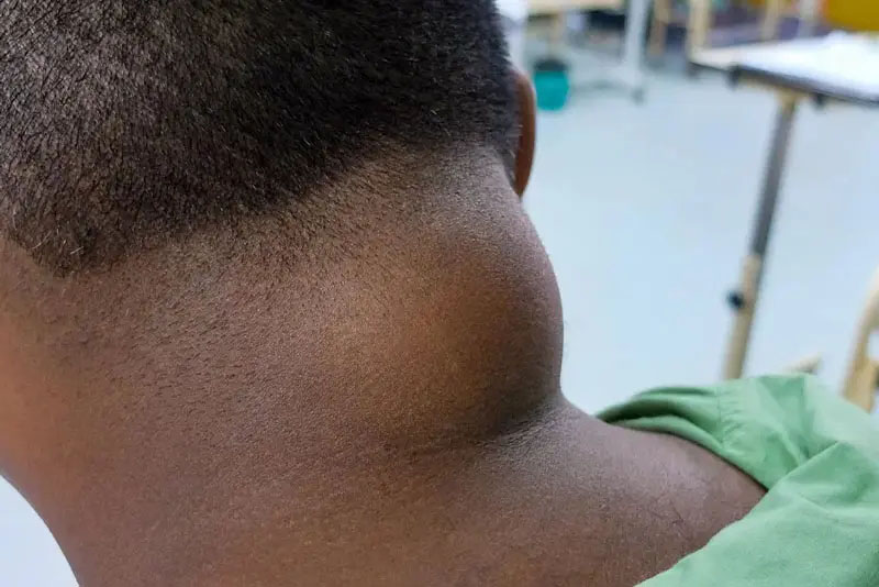 Lipoma on a person's neck