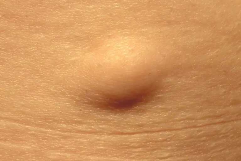 Lipoma