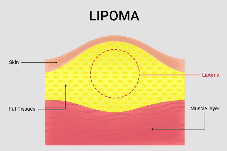 Struggling with Lipoma Removal? Manchester Lumps Clinic is Here to Help